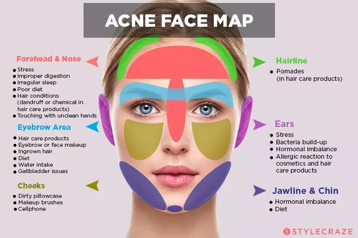 Acne map